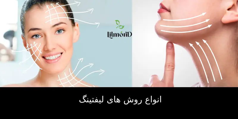 انواع روش های لیفتینگ (1)